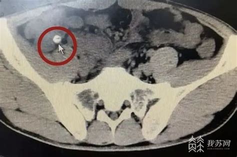 阑尾粪石图片