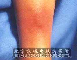 丹毒早期症状图片