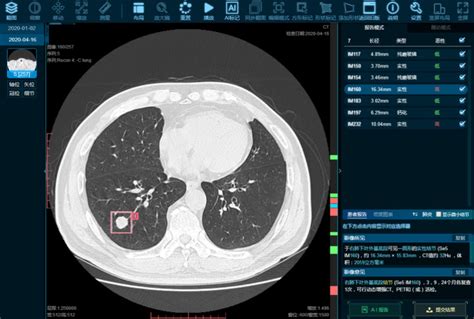 SCN-1. 肺癌筛查流程