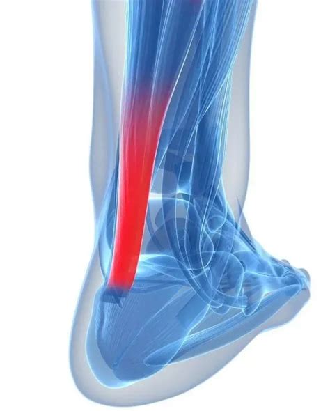 运动康复-踝关节常见损伤——跟腱炎 - 知乎