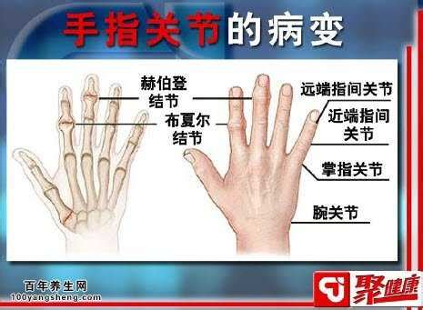 手指关节变形图片