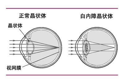 白内障手术可以等到“最后一刻”吗？ - 科普知识 - 湘潭市第一人民医院 - 国家三级甲等综合医院 湘潭市肿瘤医院