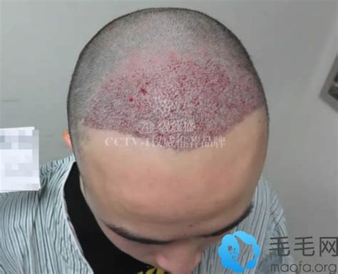 广州青逸种植毛发医院如何?植发技术怎么样?附植发价格表-发友网