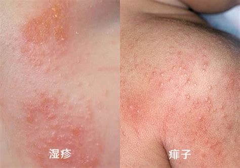 过敏和热疹的区别图片,湿疹和热疹的区别图片_大山谷图库