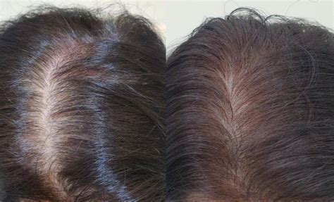 软化毛囊干细胞能促毛发生长