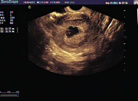 孕囊形状可以看出宝宝的性别吗 通过孕囊能看出怀了几个宝宝吗 _八宝网