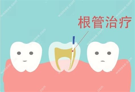 苏州根管治疗收费标准明细表含门牙|磨牙|后磨牙单颗价格 - 口腔资讯 - 牙齿矫正网
