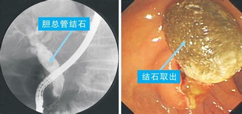 Futibatinib（TAS-120）治疗胆管癌临床数据及安全性！_患者