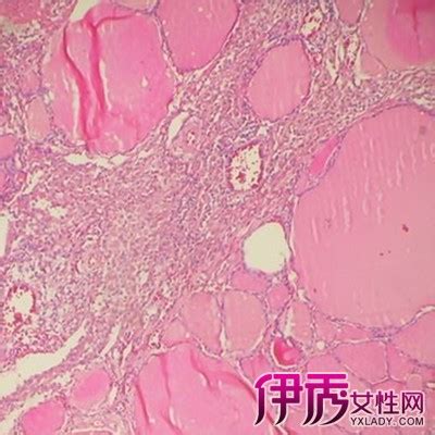 淋巴滤泡增生图片