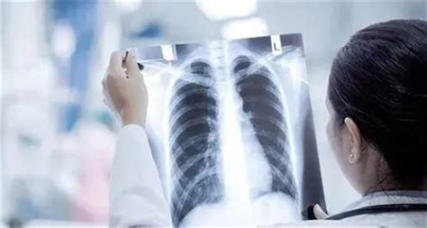 啥是“白肺”？阳了怎么判断肺部是否感染？做CT有必要吗……_澎湃号·媒体_澎湃新闻-The Paper