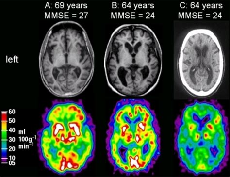 Genetic screening in sporadic ALS and FTD | Journal of Neurology ...