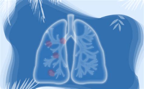 为什么EGFR抑制剂对部分肺癌腺癌的治疗效果不如化疗好-康安途海外医疗