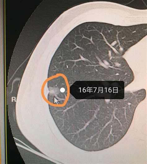 肺结节其实是肺发出的求救信号，且有相当一部分是癌前病变_39蜂疗网