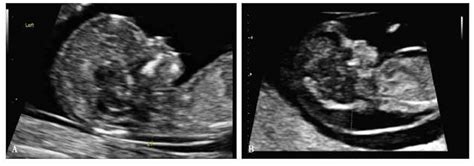 胎儿NT增厚与颈部淋巴水囊瘤的遗传咨询_染色体_综合征_努南