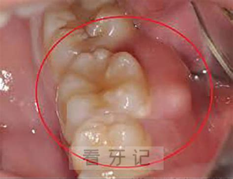 【牙龈瘤怎么治疗】【图】牙龈瘤怎么治疗有效 如何预防该症状的发生(2)_伊秀健康|yxlady.com