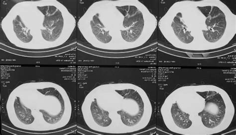 肺不张+肺实变，这些影像特征你当知！