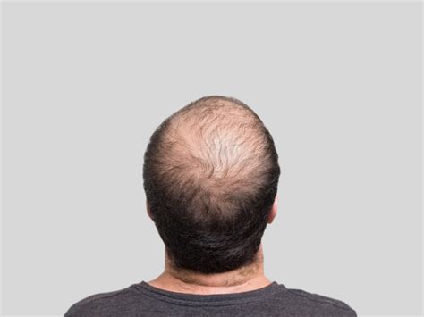 为什么医学生强烈建议脱发严重秃头用育发液，3个月蜕变“发量王者”真的那么猛？ - 知乎