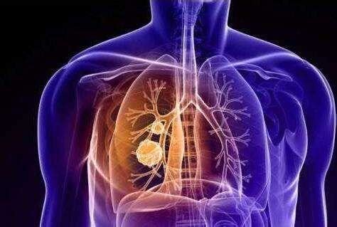 左上肺鳞癌（T4N0M0）-医联