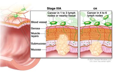结肠癌的检查方法包括哪些-结肠癌检查-复禾健康