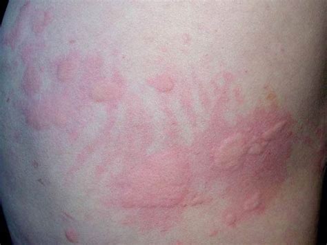荨麻疹患者需要注意什么呢_荨麻疹_北京京城皮肤医院(北京医保定点机构)