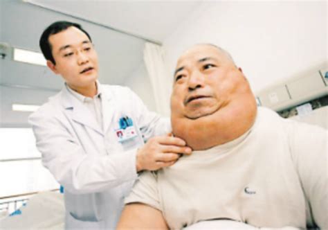 皮下脂肪瘤图片