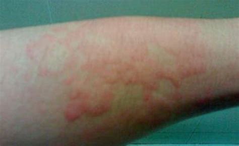 风湿性荨麻疹的症状图片_有来医生