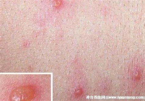 水痘的7天演变过程图片，红色斑疹丘疹到疱疹结痂(15天痊愈) — 神奇养生网