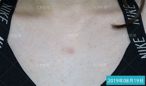 李女士前胸的小疙瘩因治疗的早已经恢复正常皮肤_北京疤痕医院_瘢痕修复_疤痕治疗_北京疤康医院【官】