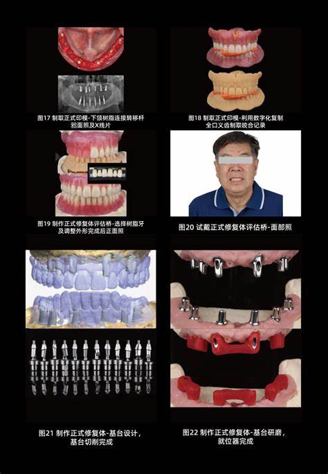 套筒冠义齿的做法步骤