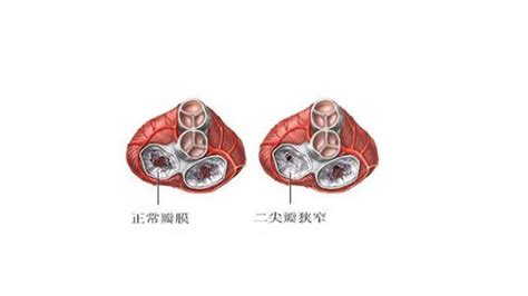 病例3 扩张型心肌病合并二尖瓣、三尖瓣、肺动脉瓣关闭不全及右心房双心室三腔起搏器置入术后(男34岁)-临床心肾彩色多普勒成像-医学