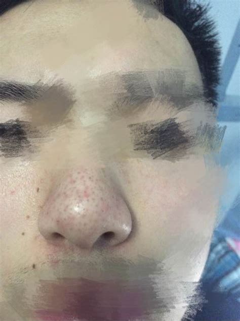 酒糟鼻图片