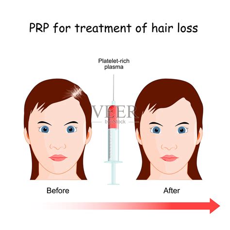 PRP治疗脱发的程序。插画图片素材_ID:393789893-Veer图库