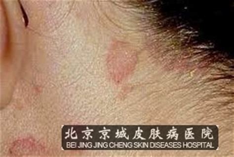 脂溢性皮炎的症状特点都有什么_皮炎_北京京城皮肤医院(北京医保定点机构)