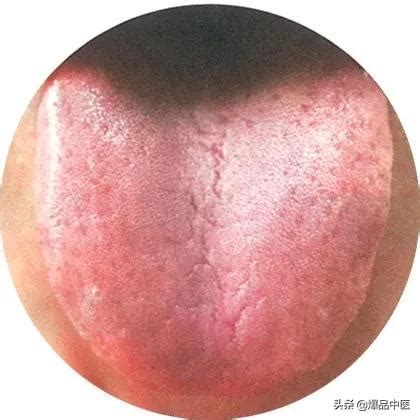 芒刺舌图片