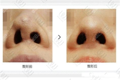 【图】进行鼻子整形疼吗 手术费用大概是多少钱(2)_鼻子整形疼吗_伊秀美容网|yxlady.com
