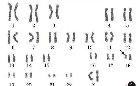 18号染色体异常六大类型：微重复、缺失对胎儿影响大-孕多多