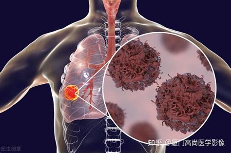 中医科学网-肺癌