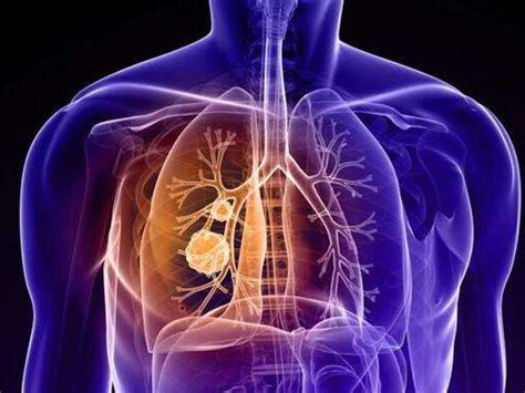 肺癌早期的8个信号, 肺癌扩散的5大征兆,千万别忽视!|Microsoft|肺癌|信号_新浪新闻