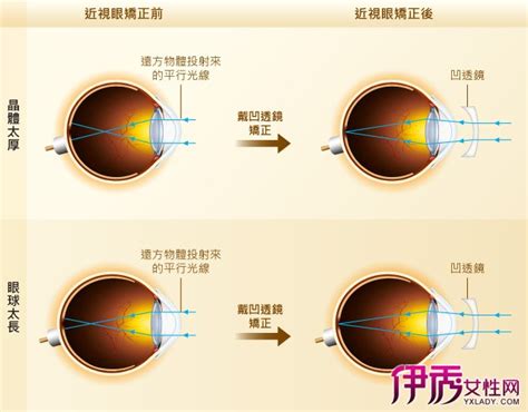 【近视眼】【图】近视眼的治疗 5种矫正近视的方法_伊秀健康|yxlady.com