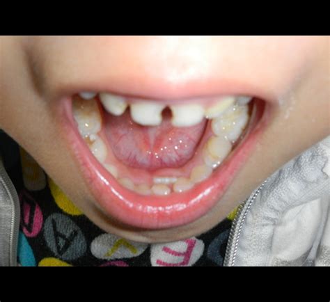 【小孩门牙掉了多久长出来】【图】小孩门牙掉了多久长出来？ 分享儿童换牙的护理事项(2)_伊秀亲子|yxlady.com