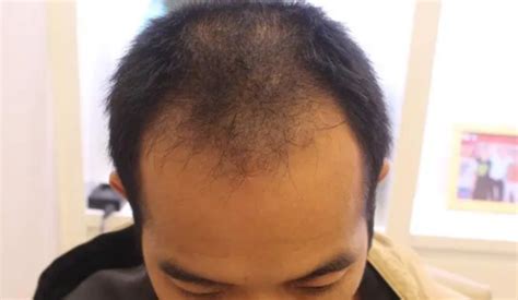 做FUT种植头发手术时间是多久？_酷知经验网