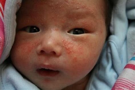 慢性和急性荨麻疹是什么原因引起的图片