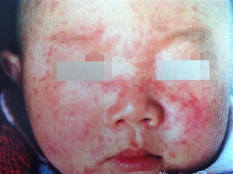 专家解析慢性荨麻疹的症状图片_荨麻疹_北京京城皮肤医院(北京医保定点机构)