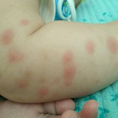 宝宝被蚊子叮了大包，如果出现这5种表现，赶快送医院！