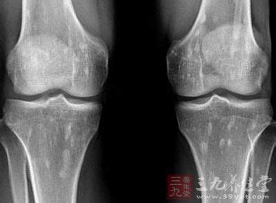 骨小梁示意图图片