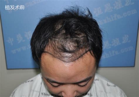 北京世熙整形医院植发科头发种植有哪些特点呢 有后遗症吗_贝贝整形网