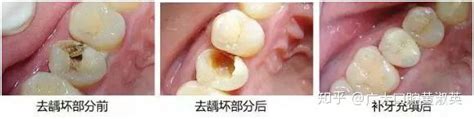 门牙切端冠折美学树脂补牙-潮州牙医黄金俊的博客-KQ88口腔博客