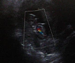 彩超单看胎儿性别，专家进 孕期，将近12周 - 百度宝宝知道