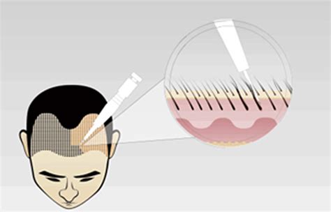 纯米胚芽提取物防治脱发的机制初探---基因表达 - 知乎