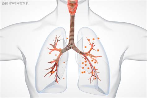 普通咳嗽与肺炎有很大区别，可通过这三种方法进行辨别，你会吗？